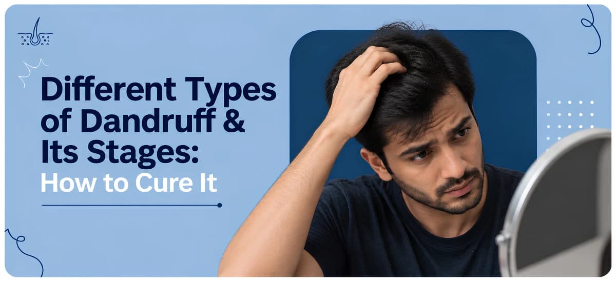 Different Types of Dandruff & Its Stages: How to Cure It